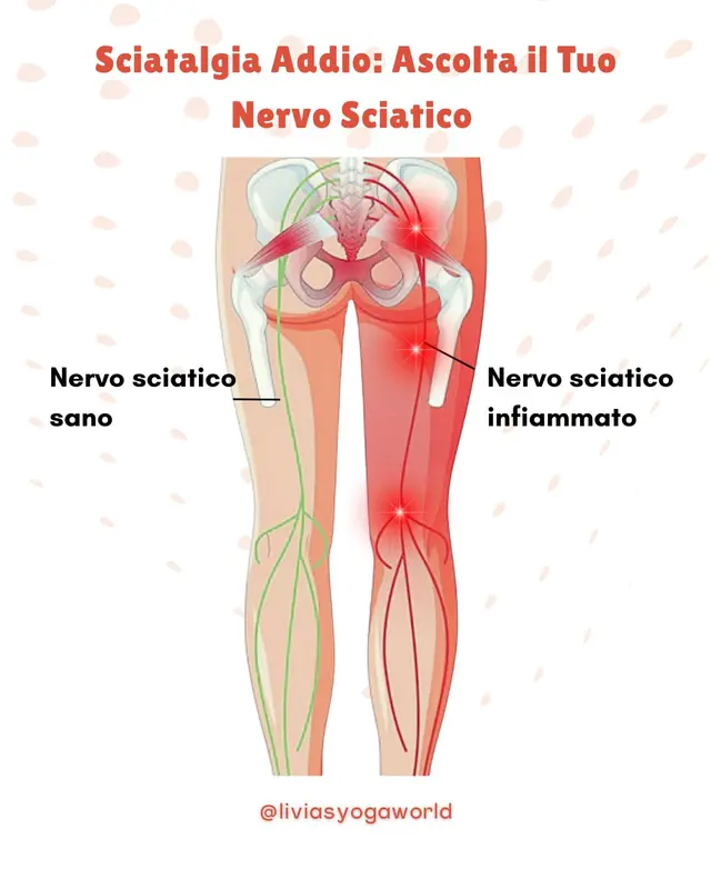 Nervo sciatico: cause fisiche, energetiche e rimedi con yoga e ascolto